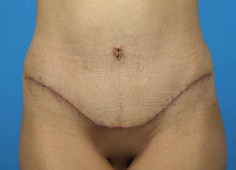 Abdominoplasty Before and After | Dr Evan W Beale