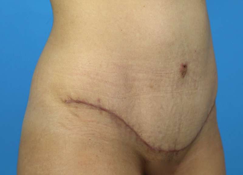 Abdominoplasty Before and After | Dr Evan W Beale