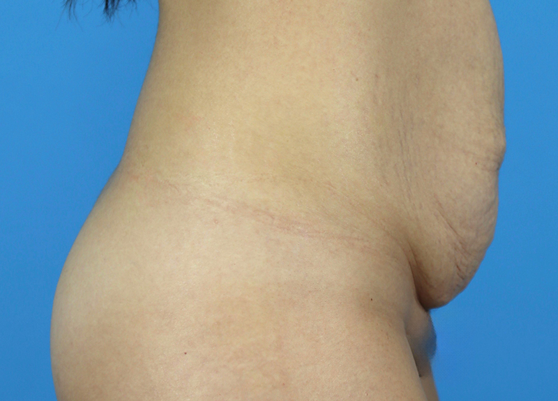 Abdominoplasty Before and After | Dr Evan W Beale