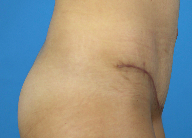 Abdominoplasty Before and After | Dr Evan W Beale