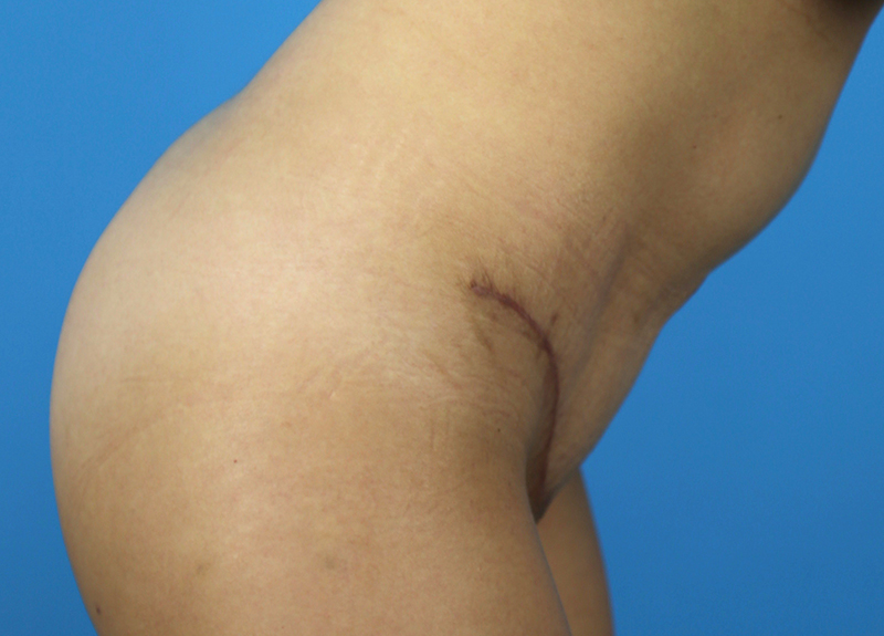 Abdominoplasty Before and After | Dr Evan W Beale