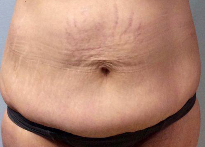 Abdominoplasty Before and After | Dr Evan W Beale