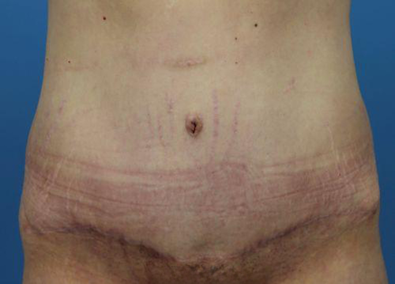 Abdominoplasty Before and After | Dr Evan W Beale