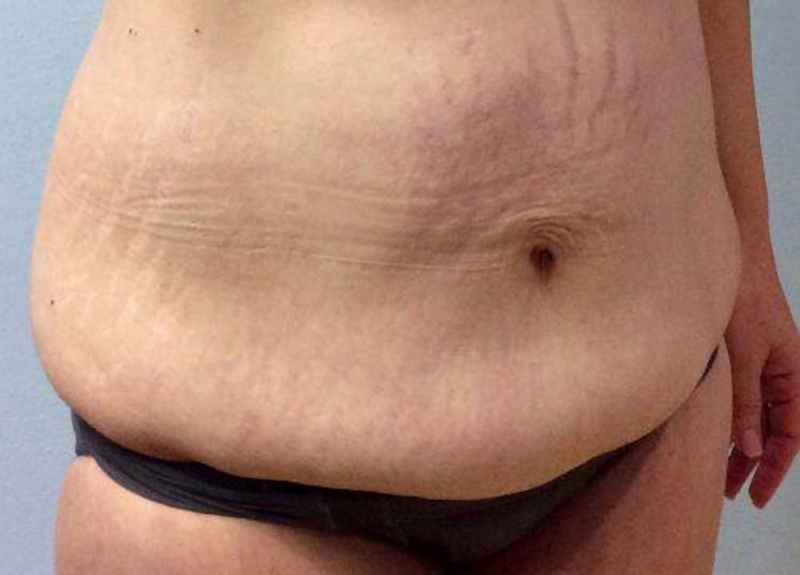Abdominoplasty Before and After | Dr Evan W Beale