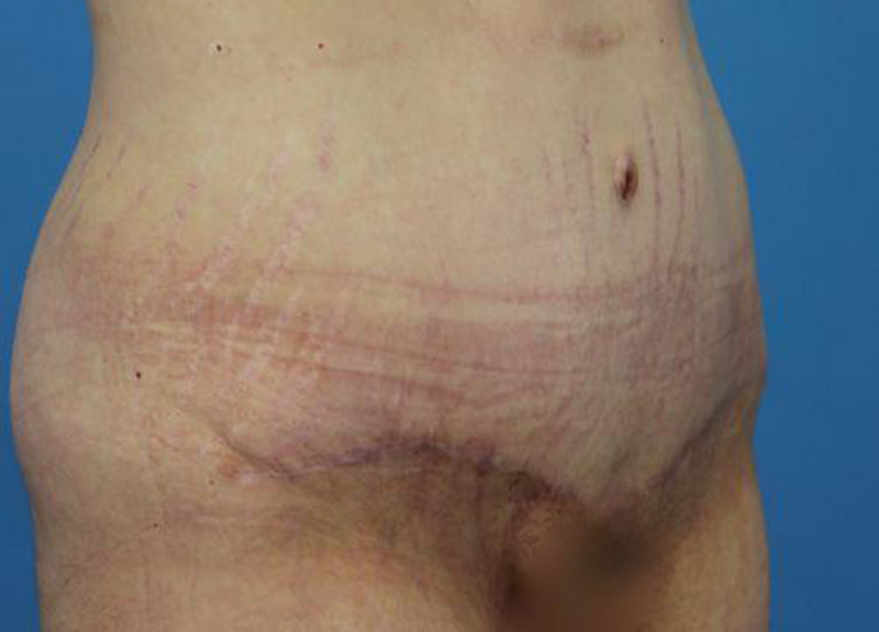 Abdominoplasty Before and After | Dr Evan W Beale
