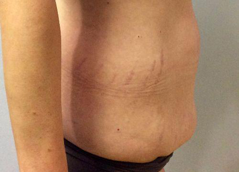 Abdominoplasty Before and After | Dr Evan W Beale