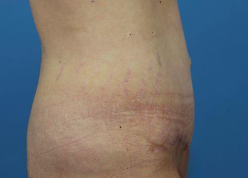 Abdominoplasty Before and After | Dr Evan W Beale