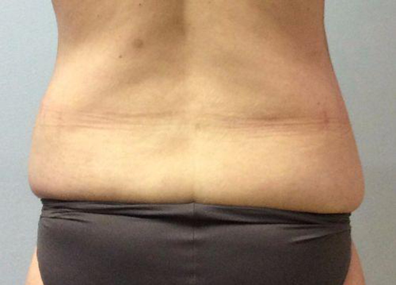 Abdominoplasty Before and After | Dr Evan W Beale