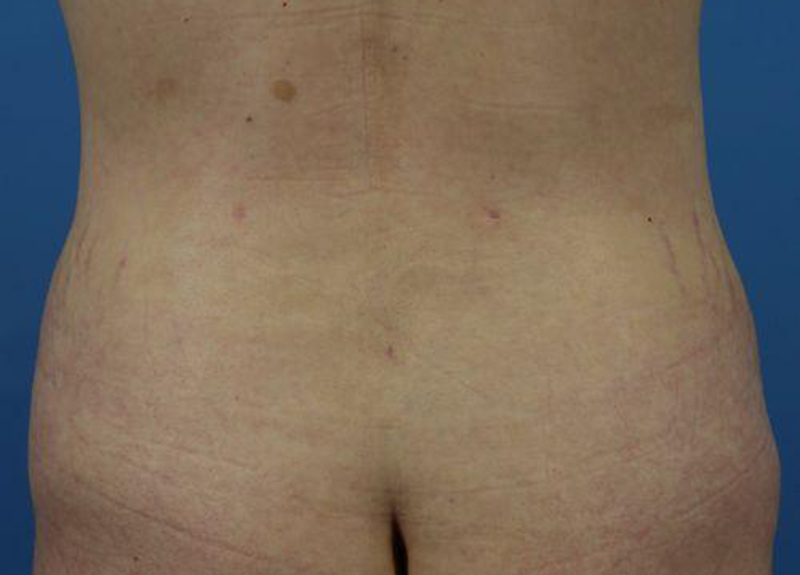 Abdominoplasty Before and After | Dr Evan W Beale