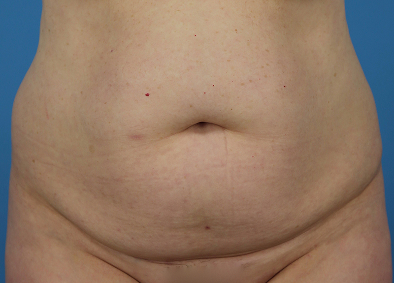 Abdominoplasty Before and After | Dr Evan W Beale