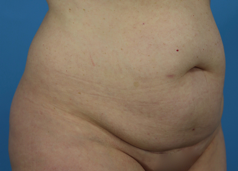Abdominoplasty Before and After | Dr Evan W Beale