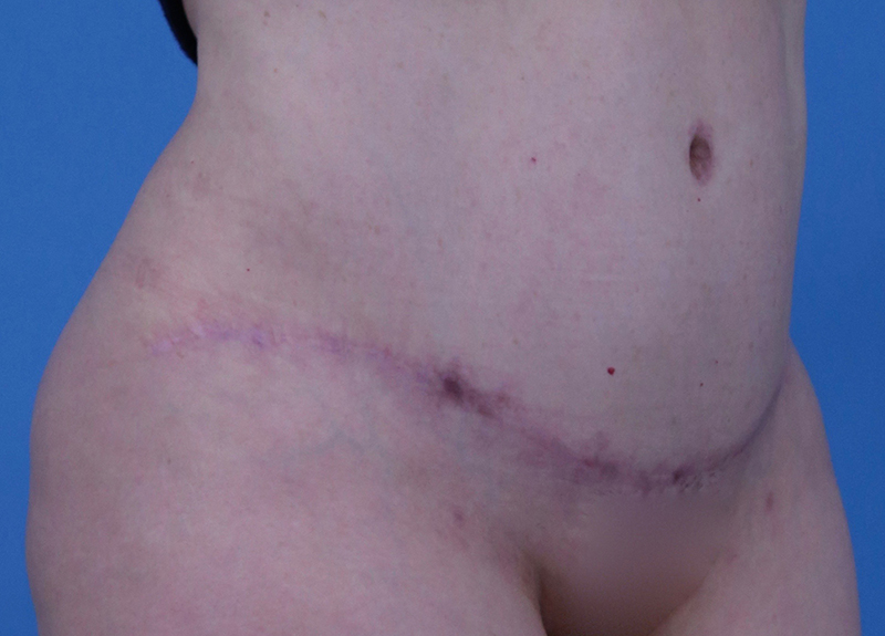 Abdominoplasty Before and After | Dr Evan W Beale