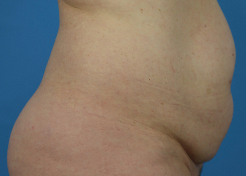 Abdominoplasty Before and After | Dr Evan W Beale