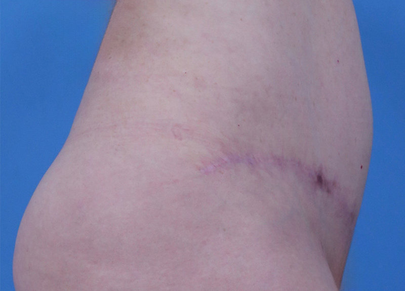 Abdominoplasty Before and After | Dr Evan W Beale