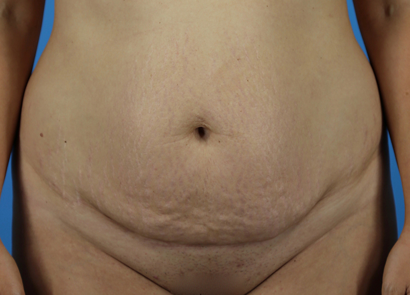Abdominoplasty Before and After | Dr Evan W Beale