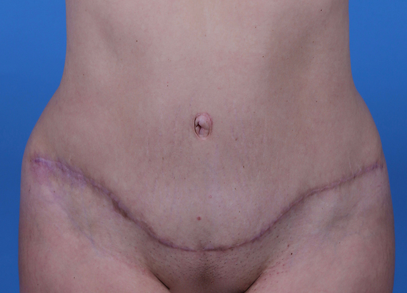 Abdominoplasty Before and After | Dr Evan W Beale