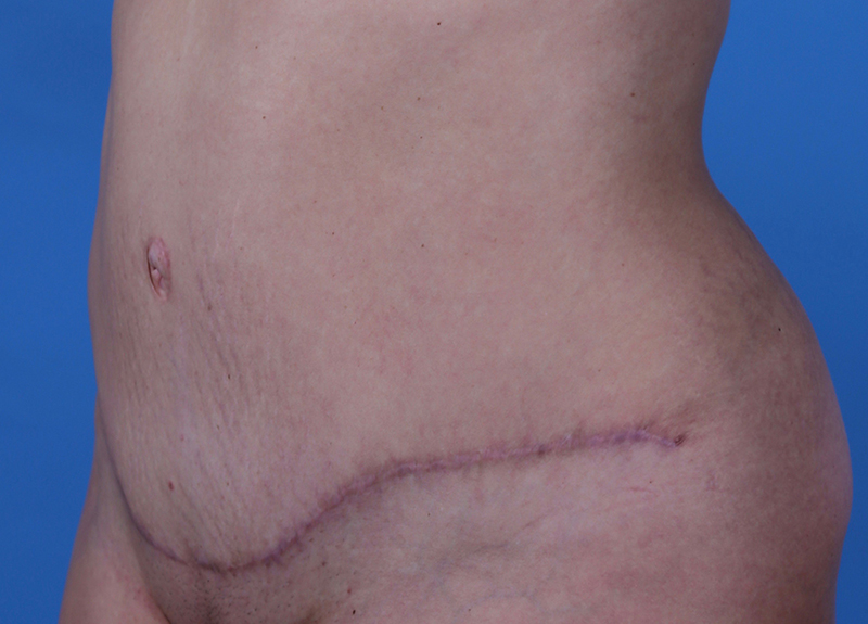 Abdominoplasty Before and After | Dr Evan W Beale