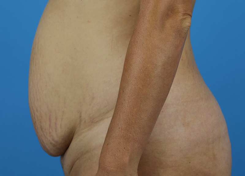 Abdominoplasty Before and After | Dr Evan W Beale
