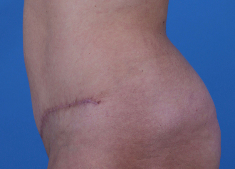 Abdominoplasty Before and After | Dr Evan W Beale