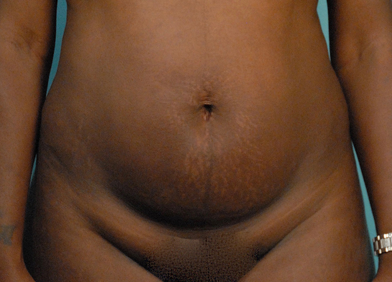Abdominoplasty Before and After | Dr Evan W Beale