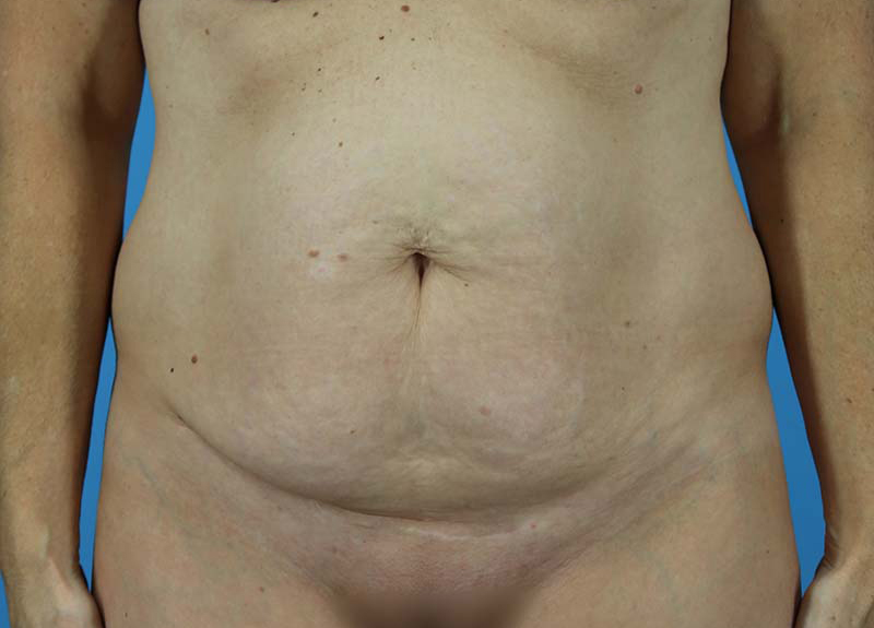 Abdominoplasty Before and After | Dr Evan W Beale