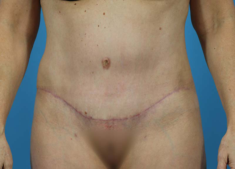 Abdominoplasty Before and After | Dr Evan W Beale