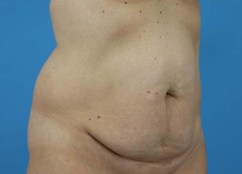 Abdominoplasty Before and After | Dr Evan W Beale