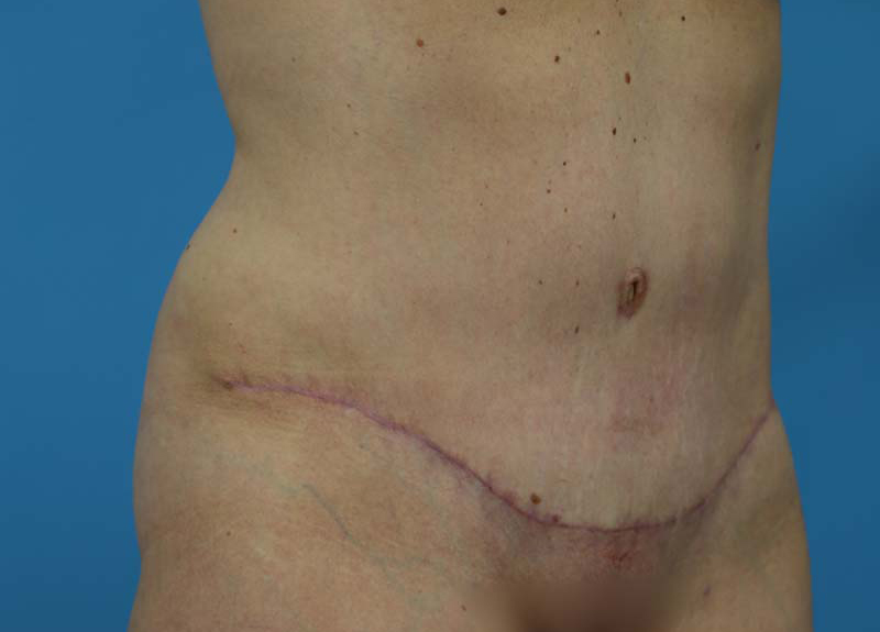 Abdominoplasty Before and After | Dr Evan W Beale
