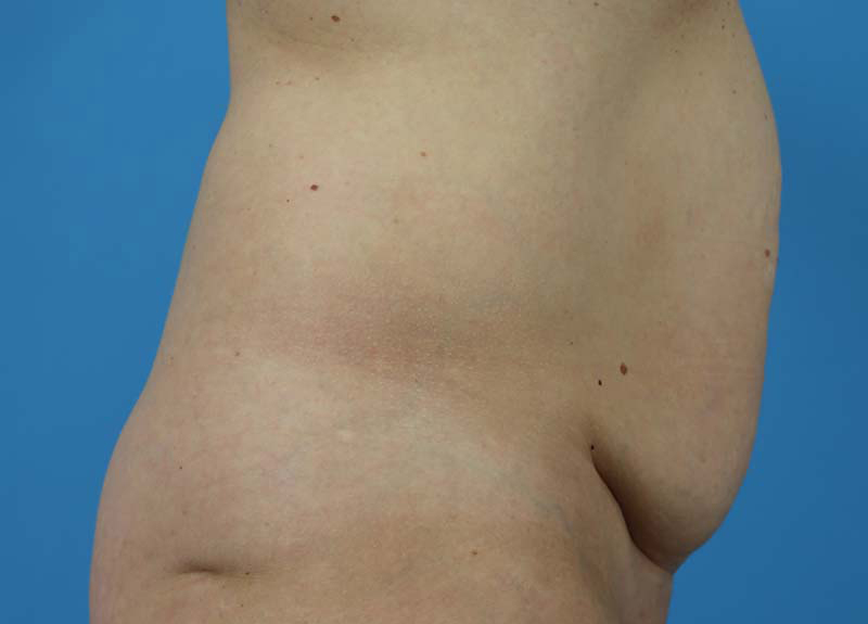 Abdominoplasty Before and After | Dr Evan W Beale