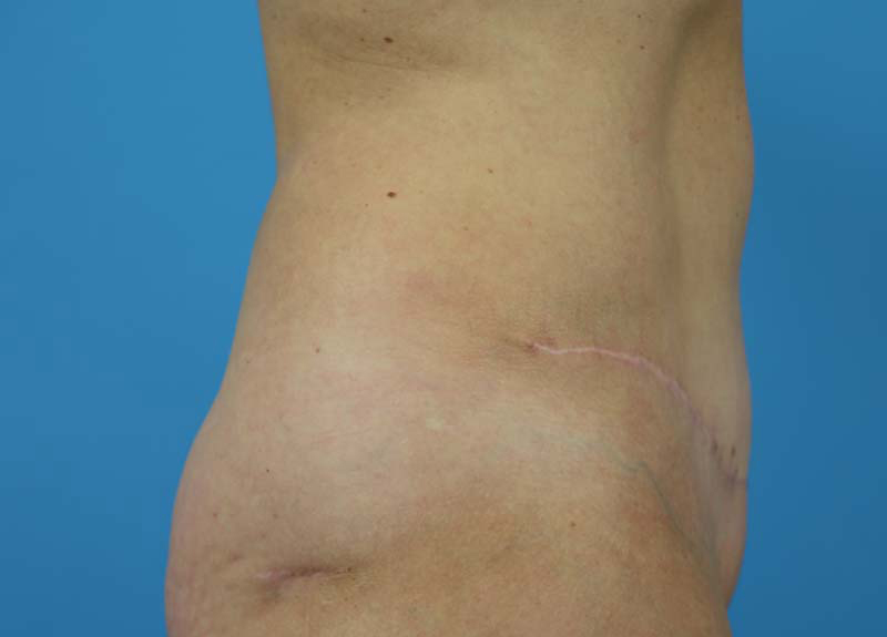 Abdominoplasty Before and After | Dr Evan W Beale