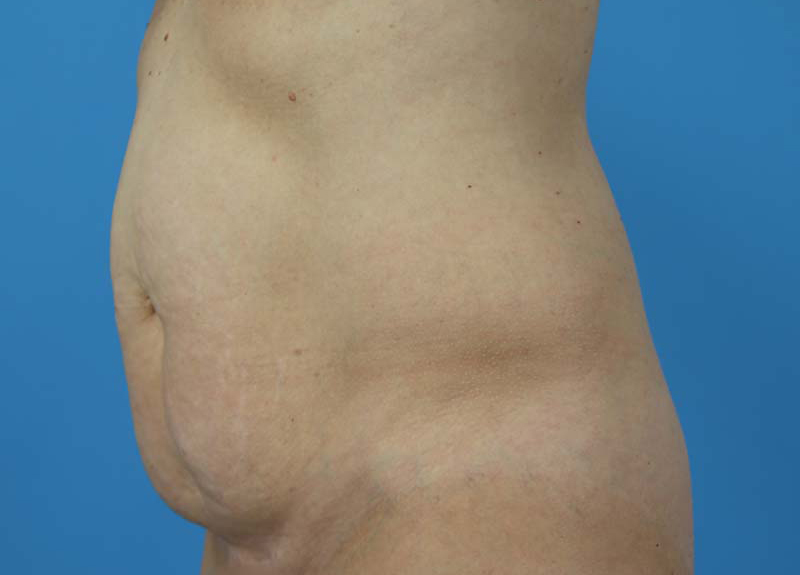 Abdominoplasty Before and After | Dr Evan W Beale