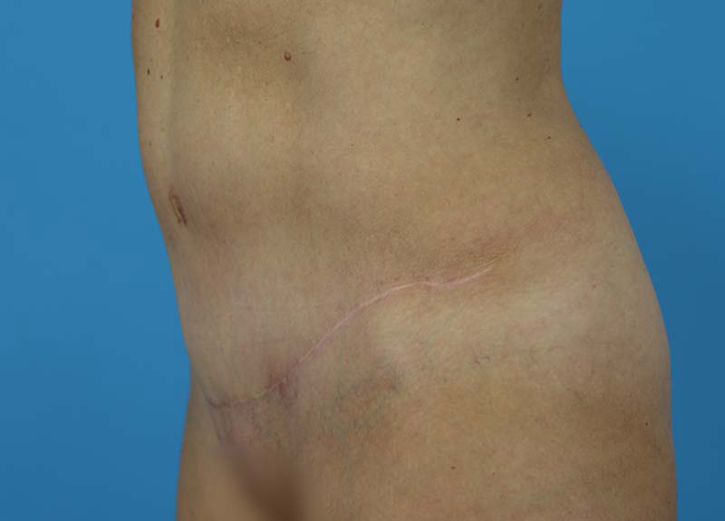 Abdominoplasty Before and After | Dr Evan W Beale