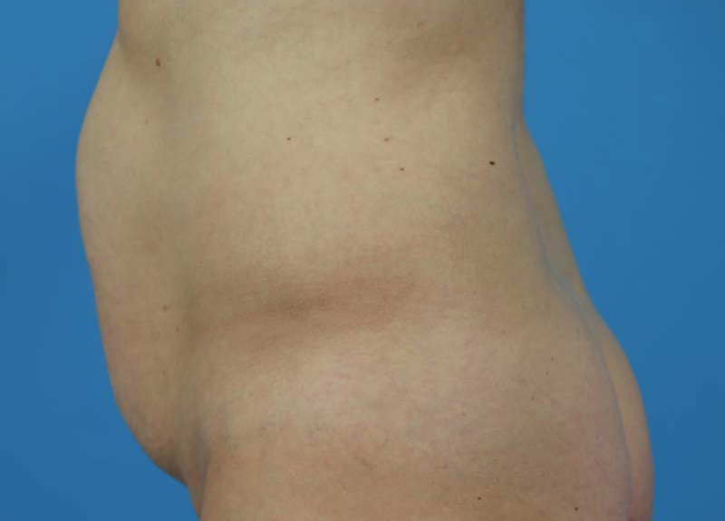 Abdominoplasty Before and After | Dr Evan W Beale