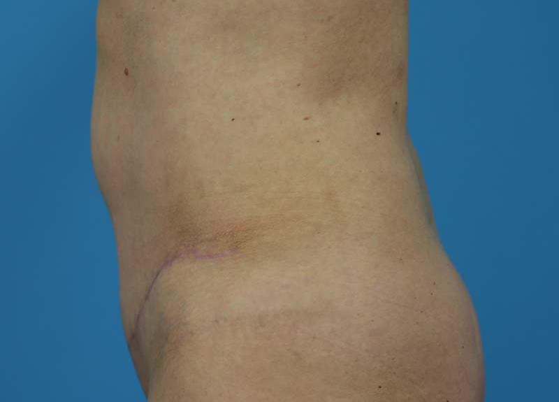 Abdominoplasty Before and After | Dr Evan W Beale