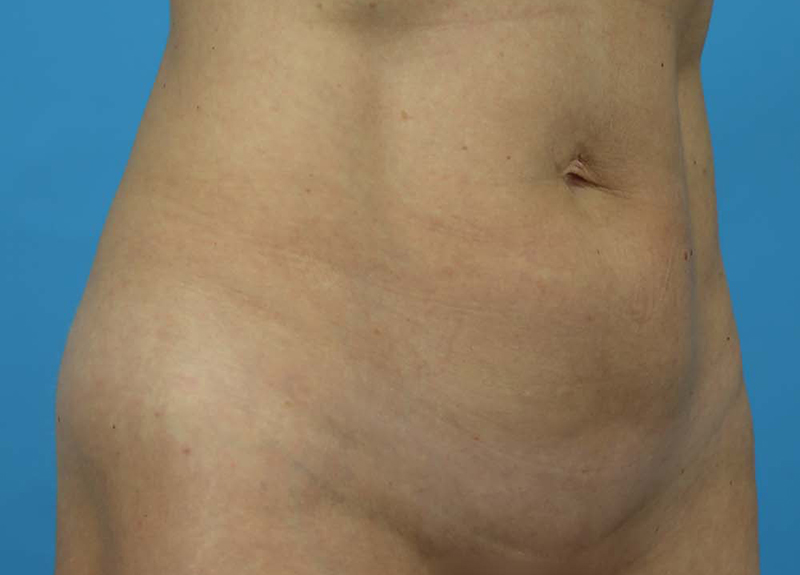 Abdominoplasty Before and After | Dr Evan W Beale