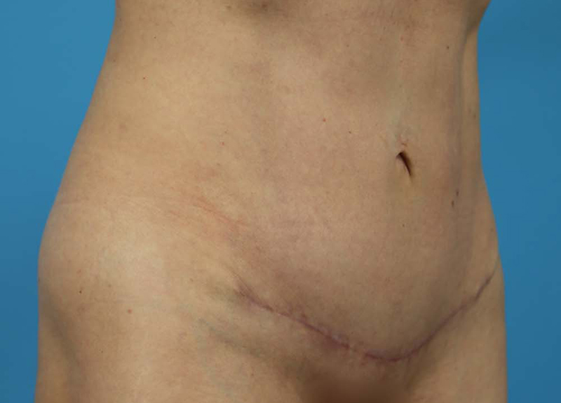 Abdominoplasty Before and After | Dr Evan W Beale