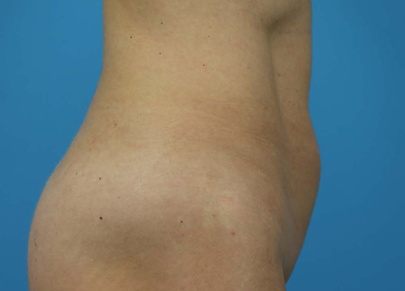 Abdominoplasty Before and After | Dr Evan W Beale