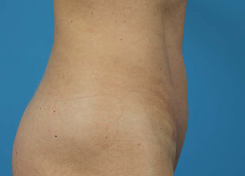 Abdominoplasty Before and After | Dr Evan W Beale