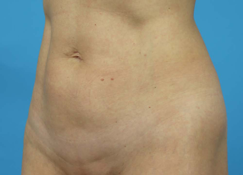 Abdominoplasty Before and After | Dr Evan W Beale