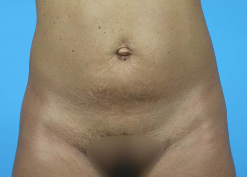 Abdominoplasty Before and After | Dr Evan W Beale