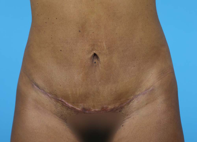 Abdominoplasty Before and After | Dr Evan W Beale