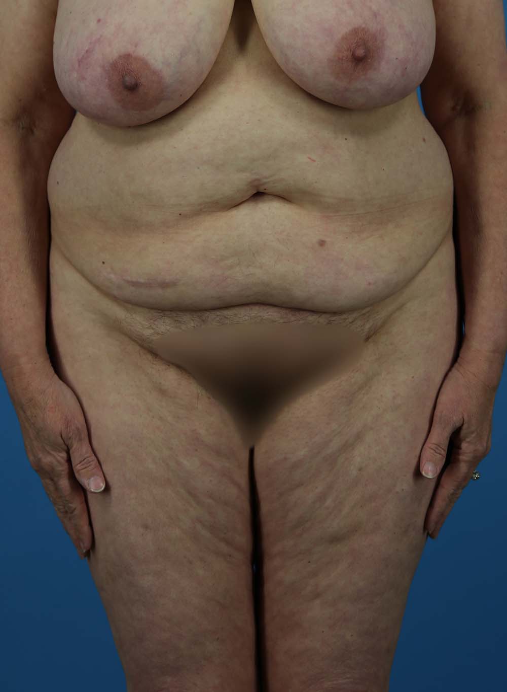 Patient 01 - Before