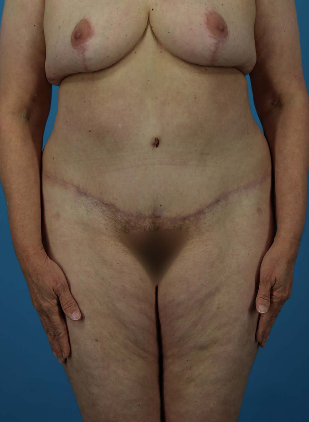 Patient 01 - After