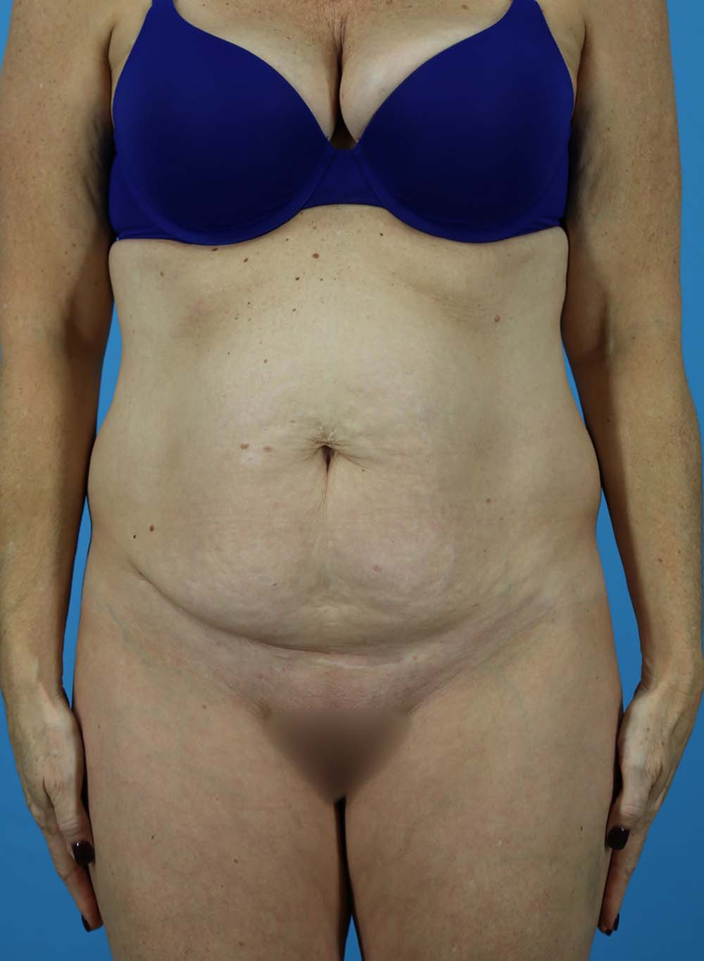 Patient 02 - Before