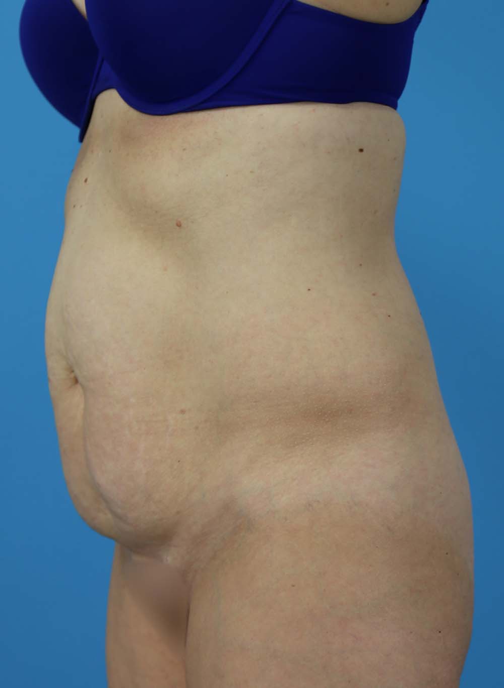 Liposuction Before and After | Dr Evan W Beale
