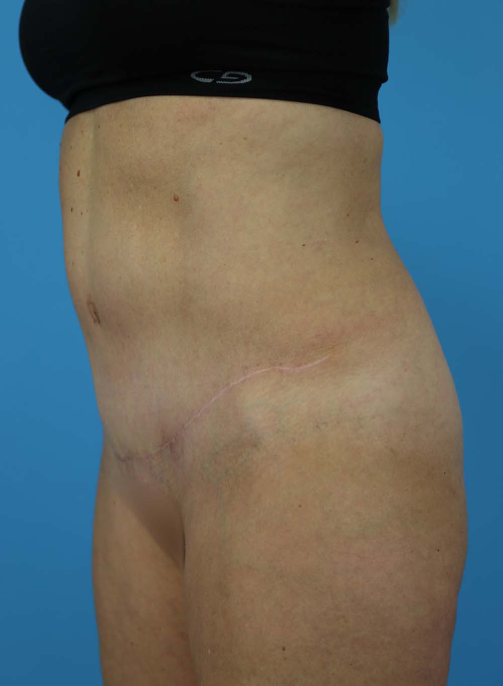 Liposuction Before and After | Dr Evan W Beale