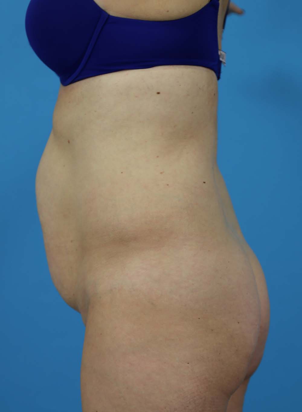 Liposuction Before and After | Dr Evan W Beale