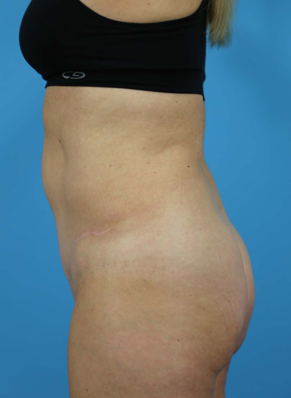 Liposuction Before and After | Dr Evan W Beale