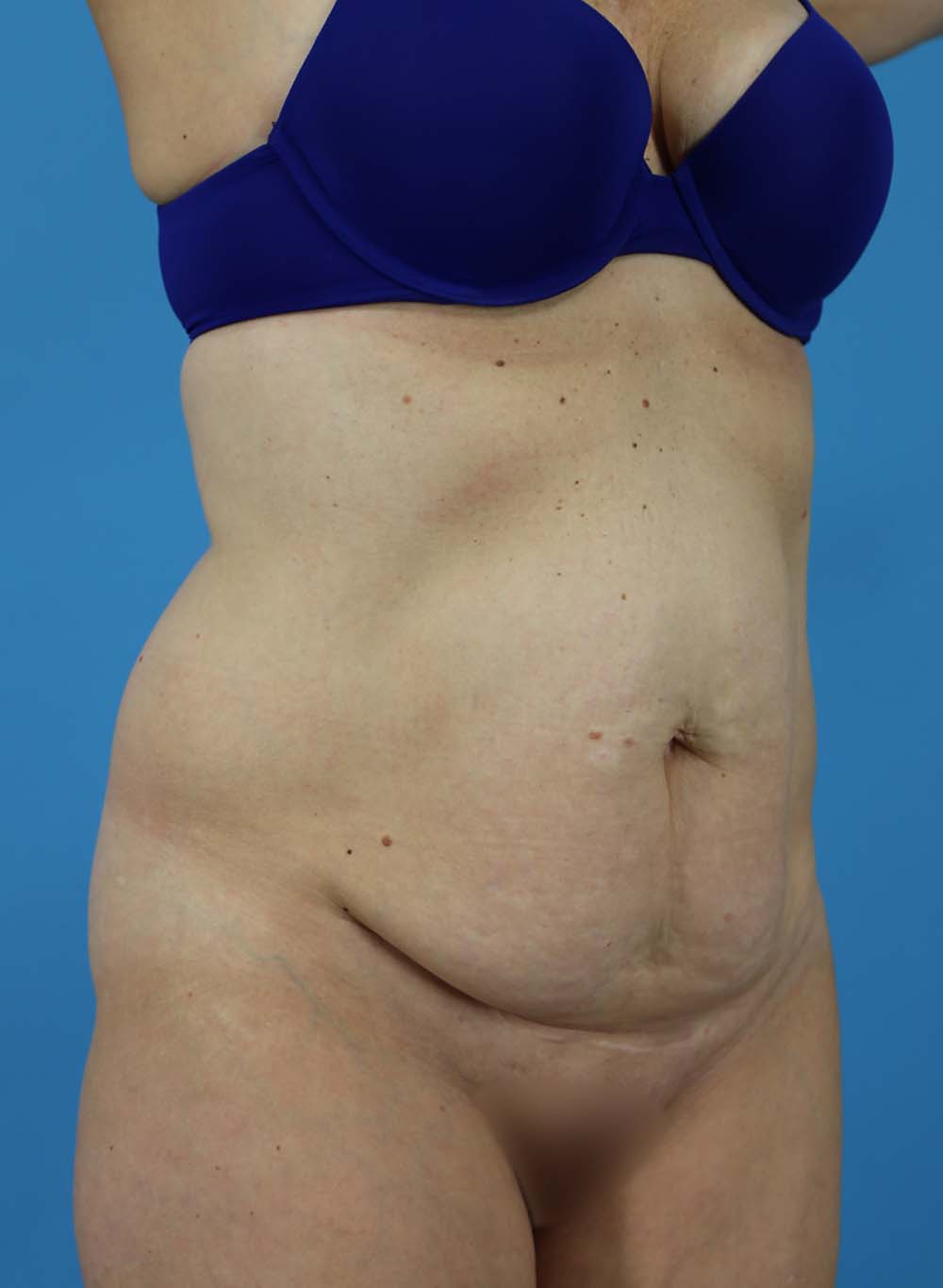 Liposuction Before and After | Dr Evan W Beale