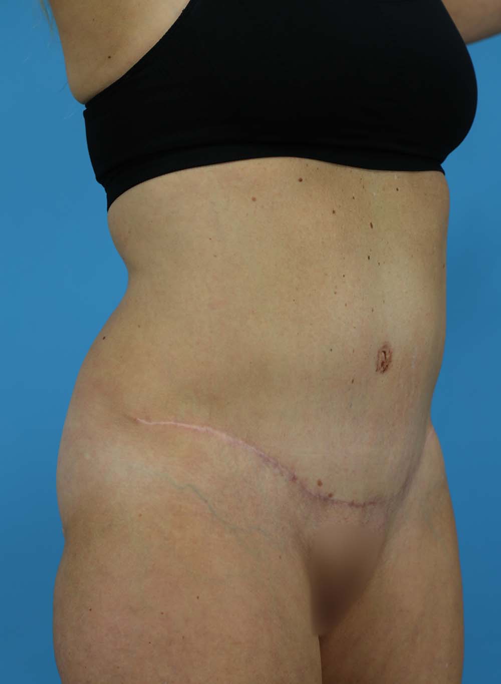 Liposuction Before and After | Dr Evan W Beale